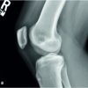 A Case Report: Bilateral Patella Stress Fractures in a Collegiate Gymnast