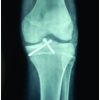 Arthroscopic Fixation of Tibial Spine Avulsion Fracture in Open Physis