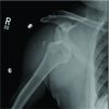 Axillary Artery Injury Following Closed Reduction of an Age-Indeterminate Anterior Glenohumeral Dislocation
