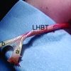 Trifurcate Origin of Long Head of Biceps Brachii: A Case Report and Literature Review