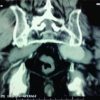 Sciatic Nerve Palsy due to a Superior Gluteal Artery Pseudoaneurysm PostBone Marrow Biopsy: A Case Report and Review of the Literature