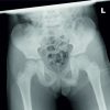 Pelvic Osteomyelitis in a Child – A Diagnostic Dilemma