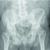 An Unusual Presentation of Hip Pain in a Patient with Known Hyper-IgE Syndrome and Multiple Calcified Pelvic Apophyses