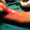 Schwannoma of the Median Nerve at Mid Forearm Level