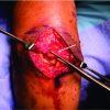 Complete Rupture of the Triceps Tendon and Ulnar Collateral Ligament of the Elbow in a 13-Year-Old Football Player: A Case Report