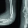 Type III Monteggia Equivalent Lesion with Ipsilateral Fracture Lateral Condyle of Humerus in a Four-year-old Child: A Case Report and Literature Review