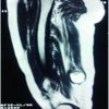 A Rare Case of Glomus Tumor of the Thigh with Literature Review