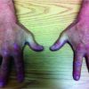 Supercharge End-to-Side Anterior Interosseous Nerve to Ulnar Motor Nerve Transfer for Severe Ulnar Neuropathy: Two Cases Suggesting Recovery Secondary to Nerve Transfer