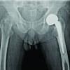 Non-traumatic Unilateral Femur Neck Fracture in a Human Immunodeficiency Virus-Positive Septuagenarian Indian Male: A Unique Case Report.