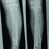 Periprosthetic Tibial Fracture with Nonunion and Ascending Prosthetic Joint Infection: A Case Report of an Individual Treatment Strategy