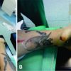 Open Treatment of Closed Talus Dislocation without Fracture: A Case Report and Literature Review