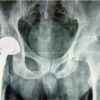Bipolar Hemiarthroplasty of Hip in an Unstable Angina Patient: A Case Report