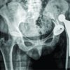 Dissociation of Cemented Dual Mobility Socket from the Acetabulum in A Case of Recurrent Total Hip Arthroplasty Instability -A Novel Complication