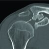 Clavicular Osteochondroma: Extremely Rare Cause of Impingement Syndrome