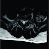 Delayed Presentation of a Symptomatic Psoas Hematoma Following Lumbar Vertebral Kyphoplasty for Myeloma: A Case Report