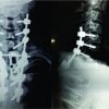 Paratesticular Paraganglioma with Metastasis to D1 Vertebra- A Case Report and Review of Literature