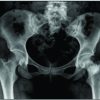A Case Report of Curettage and Kryptonite® use in Proximal Femur Intraosseous Lipoma