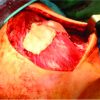 Complete Intrasubstance Long Head Biceps Brachii Rupture with Successful Repair: A Case Report