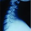 Spinal Cord Injury Due to Cervical Disc Herniation without Bony Involvement Caused by Wrestling – A Case Report