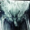 Massive FungatingEwing’s Sarcoma of Scapula Treated by Limb Salvage Surgery: A Case Report