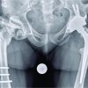 Challenging Implantation of Hip Prosthesis in a 32-year-old Patient with Kniest Syndrome