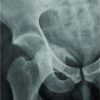 Obturator Dislocation of the Hip with Associated Femoral Head Impaction and Medial Wall Fracture of the Acetabulum