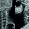Osteoid Osteoma of Cervical Spine: A Case Report and Review of Literature
