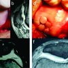 Autologous Osteochondral Transplantation in Full-thickness Patella Chondral Lesion: A Case Series
