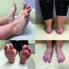 Congenital Unilateral Hypertrophy of the Foot Intrinsics: A Rare Case and Review of Literature