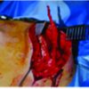 Transfer of the Lower Trapezius as a Surgical Treatment for Combined Injuries to the Suprascapular and Axillary Nerves: A Case Report