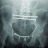 Midline Longitudinal Sacral Fracture in an Anterior-Posterior Compression Pelvic Injury -A Surgical Decision-making and Outcome