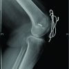 Gap Non-union Patella Fractures: Case Report and Review of the Literature