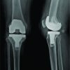 Para-articular Osteochondroma of Patella with Coexisting Osteoarthritis