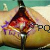 Volar Locking Plate Fixation of Distal Radius Fracture with a Flexor Carpi Radialis Brevis and a Hypoplastic Pronator Quadratus