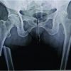 Intramedullary Nailing: Definitive as well as Prophylactic Fixation Method in a Case of Bilateral Atypical Femoral Fractures – A Case Report