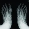 Long Term Result of Weil Osteotomy and Callotasis for Bilateral Brachymetatarsia: A Case Report