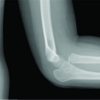 A Long-standing Monteggia Fracture in a Child who underwent Bone Lengthening and Annular Ligament Reconstruction: A Case Report