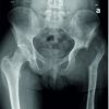 Resection Arthroplasty Treatment Possibility for a Patient with Fibrous Dysplasia, Chronic Osteomyelitis, and Recurrent Periprosthetic Hip Joint Infection: A Case Report