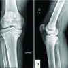 Nosocomial Chronic Osteomyelitis of the Tibia in an Otherwise Healthy Adolescent: A Case Report
