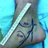 The Intraneural Ganglion Cyst of the Tibial Nerve: A Case Report and Review of Literature