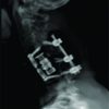 Delayed Diagnosis and Management of Traumatic Cervical Spine Subluxation