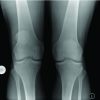 Non-Identical Bilateral Rupture of the Extensor Mechanism of the Knee in a Patient with Hyperlipidemia: A Case Study