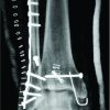 Trimalleolar Fracture-Dislocation of the Ankle with a Double Fragment of the Medial Malleolus: A Separate Fracture Subtype?
