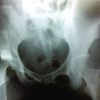 Case Report of a Rare Pipkin Type III Femoral Head Fracture