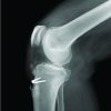 Repair of Patellar Tendon Avulsion from the Tibial Tubercle: Case Report