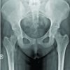 Epithelioid Osteoblastoma of the Proximal Femur in a 19-Year-Old Female: A Case Report and Review of Literature