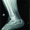 Bimalleolar Fracture: A Unique Case of Complication of Complex Regional Pain Syndrome of Lower Extremity After Prolonged Undue Immobilisation