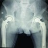 SubcapitalNeck of Femur Fracture in a Case of Osteonecrosis of Femoral Head – Rare Presentation