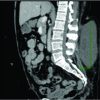 Surgical Treatment of a Chronic Morel-Lavallée Lesion: A Case Report