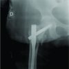Injury to the Superior Gluteal Artery during Intramedullary Fixation of a Proximal Femoral Fracture – A Case Report